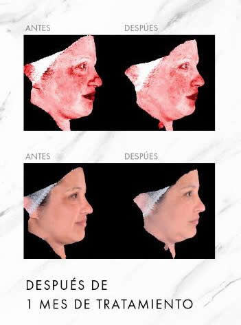 Antes y despues de un mes de tratamiento